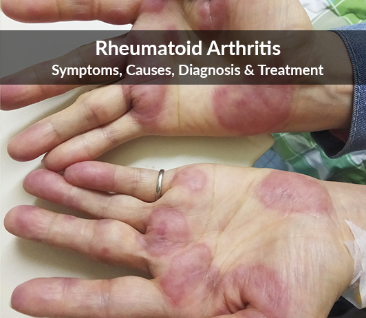 Rheumatoid Arthritis- Symptoms, Causes, Diagnosis & Treatment Rheumatoid Arthritis: Symptoms, Causes, Diagnosis & Treatment