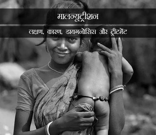 6 Malnutrition in Hindi मालन्यूट्रीशन: लक्षण, कारण, डायगनोसिस और ट्रीटमेंट