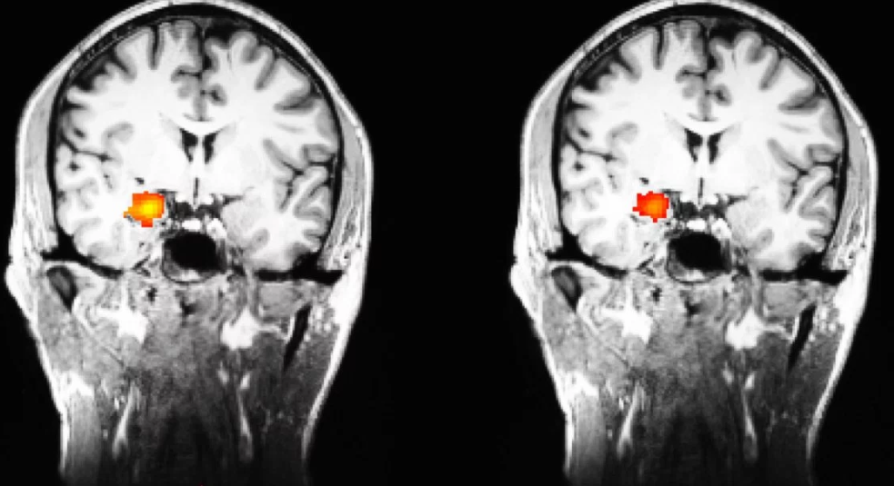 Harvard Mindfulness Meditation Study: Decreased Activity in Amygdala
